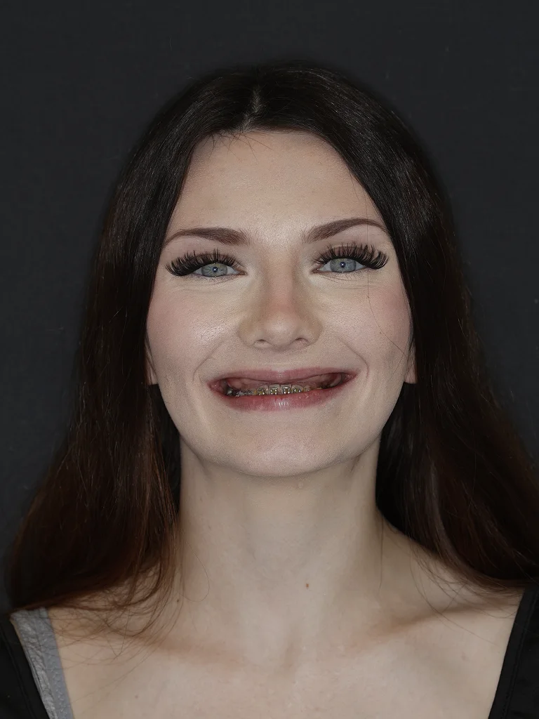 Rachel before dental implants